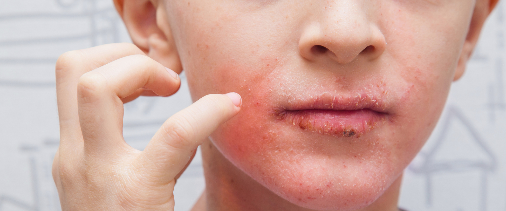 Mikä on atooppinen ihottuma ja miten tunnistat sen oireet?