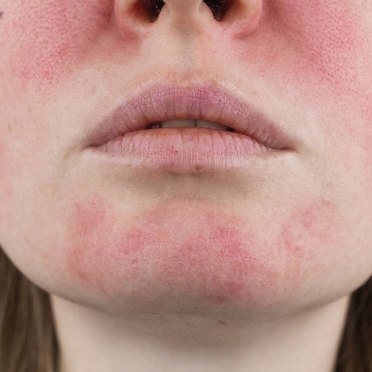 Miksi atooppinen ihottuma pahenee talvella ja miten estät sen?