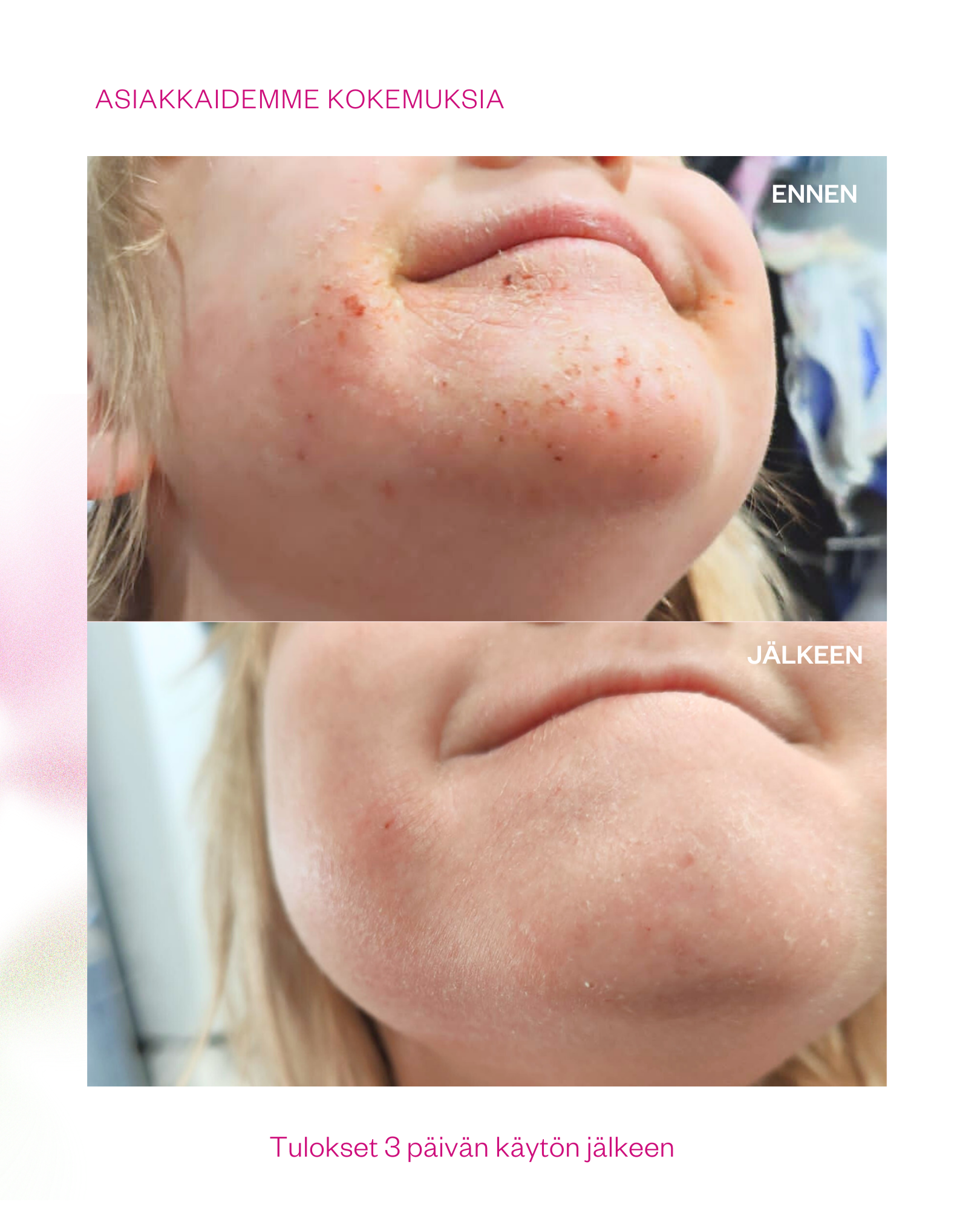 Propolis & Probiotics Rescue Cream erikoisvoide atooppiselle ja ongelmaiholle