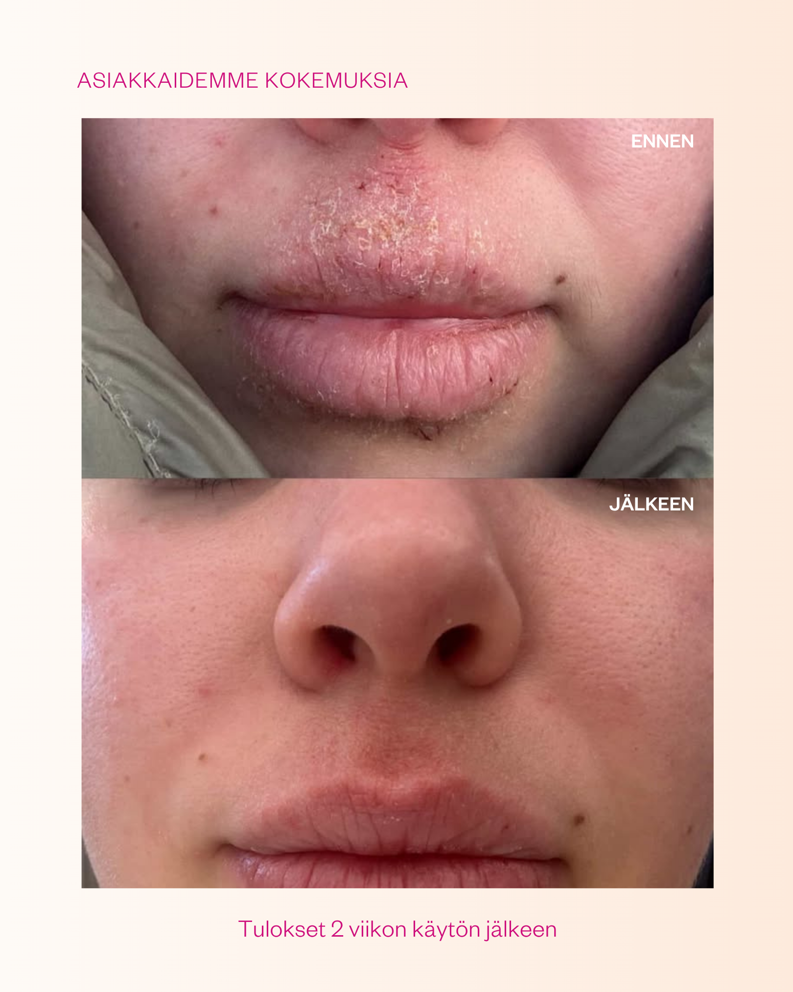 Propolis & Probiotics Rescue Cream erikoisvoide atooppiselle ja ongelmaiholle